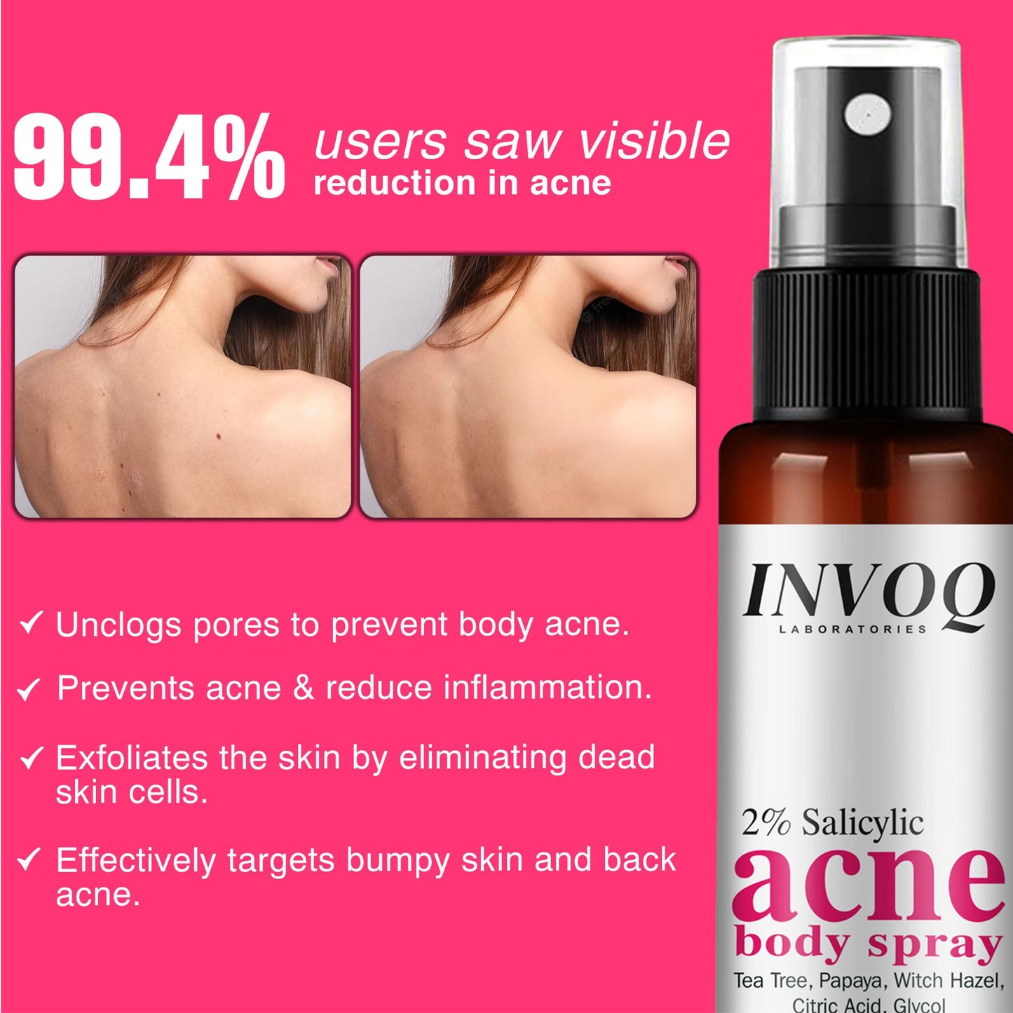 Salicylic Body Acne